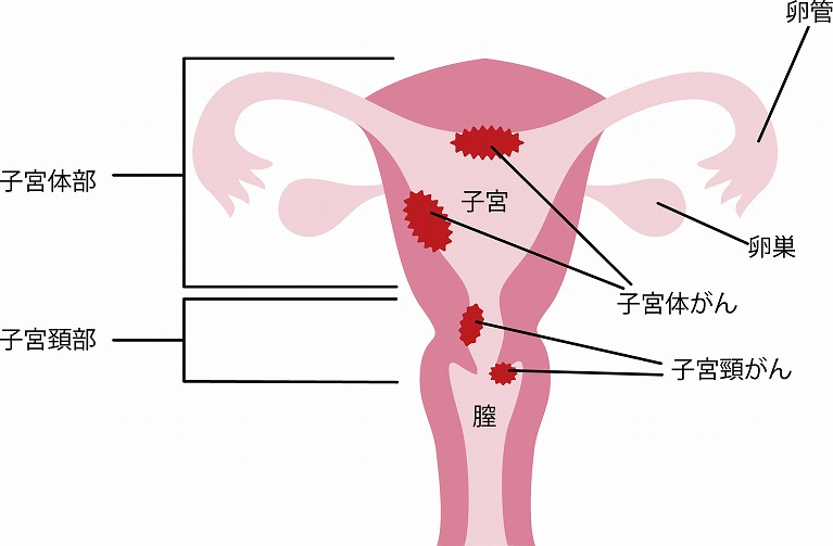 子宮頸がんワクチンとは