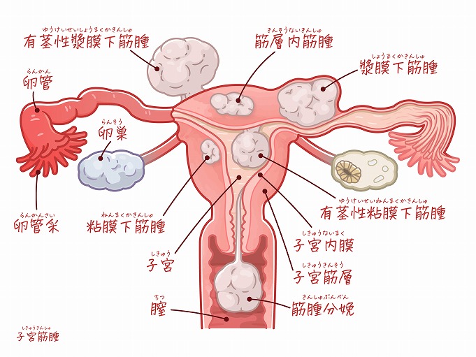 子宮 子宮内膜症 | 主な婦人科疾患 | 医療法人社団實理会 東京国際 ...