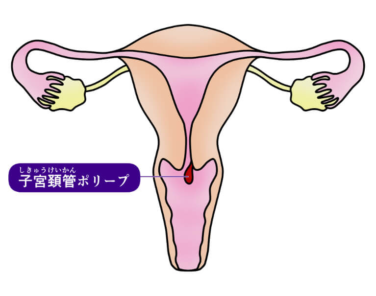 子宮頚管ポリープとは